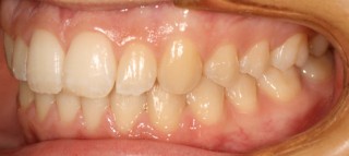 Intraorales Bild03 [320x200]