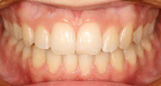 Intraorales Bild04 [320x200]